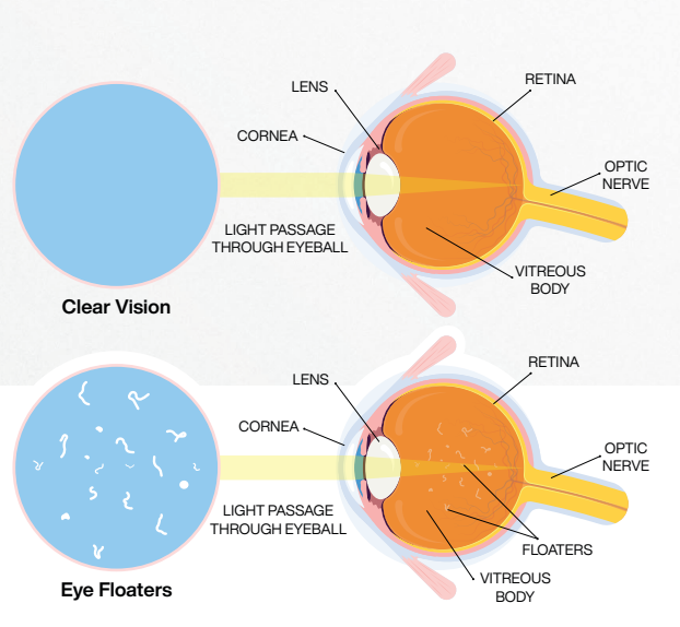 Vitreous floaters pic